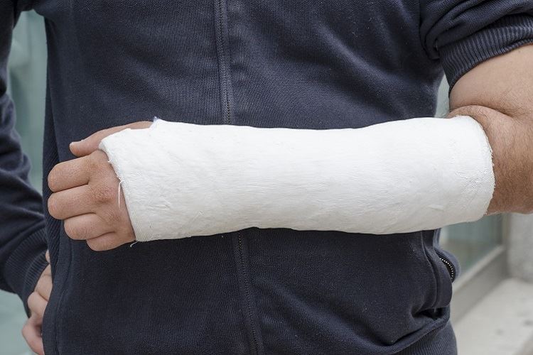 Broken arm in cast